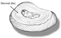 anatomy_normaldisc_200_126_80